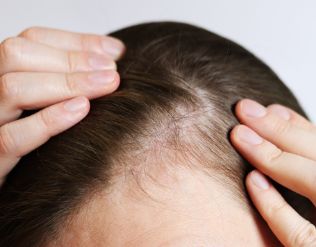 Frauenhaartransplantation – Ursachen, Ablauf und Ergebnisse