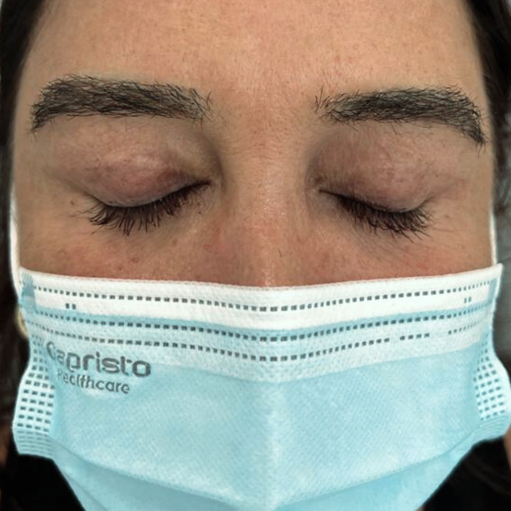 Augenbrauentransplantation