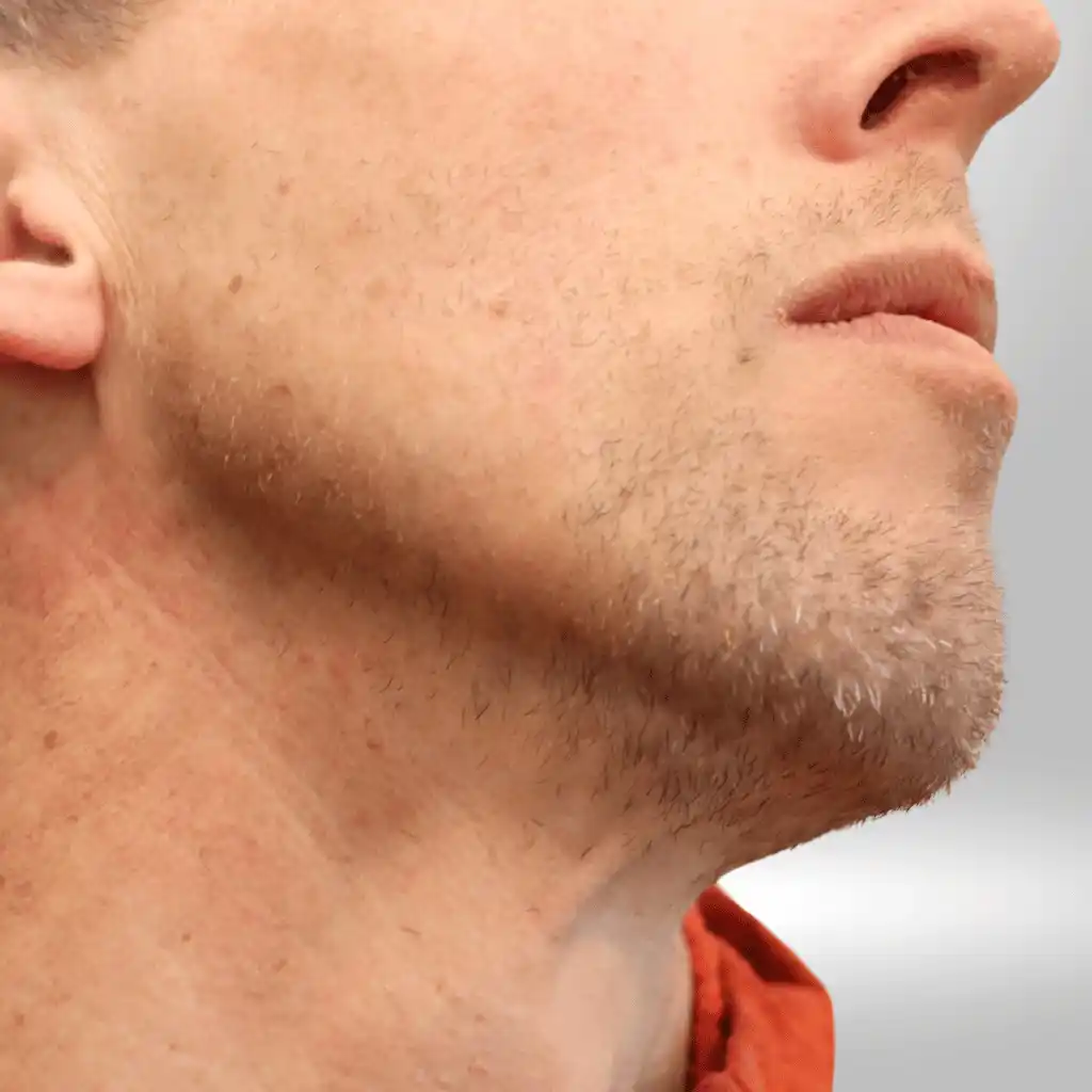 Barttransplantation — Vorher