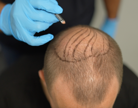 Eigenhaartransplantation Kosten – Was Sie über Preise und Leistungen wissen sollten