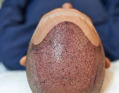 FUE Haartransplantation Kosten – Was Sie über Preise und Leistungen wissen sollten