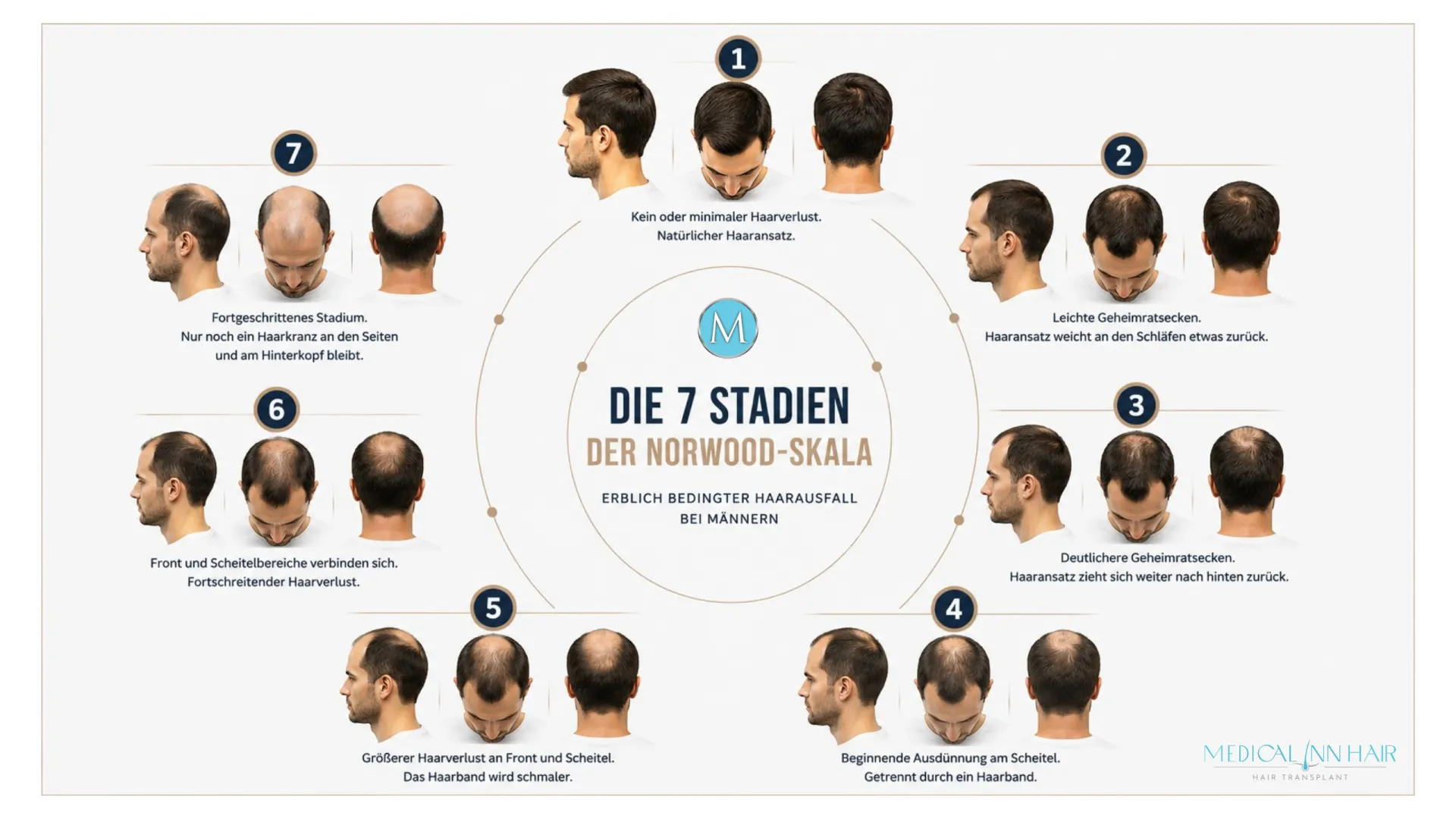 Die Norwood-Skala – Wie weit ist Ihr Haarausfall fortgeschritten?