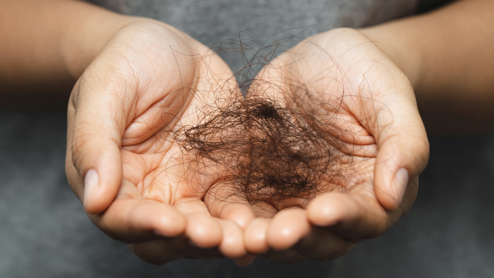 Diffuser Haarausfall bei Frauen – Ursachen & wann eine Haartransplantation sinnvoll ist