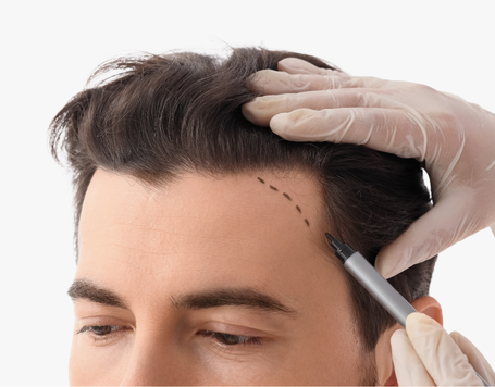 Haarausfall Behandlung – Therapien im Vergleich