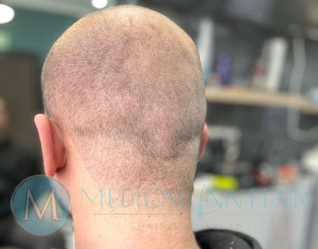 Narbenfreie Haartransplantation – Mythos oder Realität?