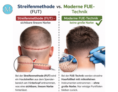 Narbenfreie Haartransplantation – Mythos oder Realität?