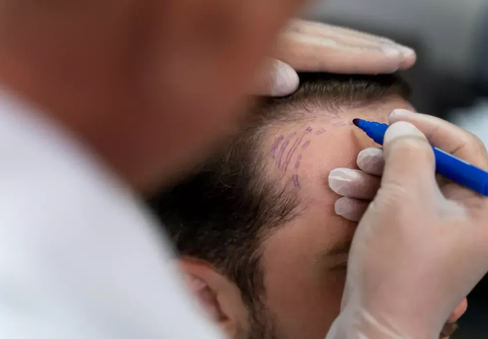 Wann sollte man nach einer Haartransplantation in die Sonne gehen